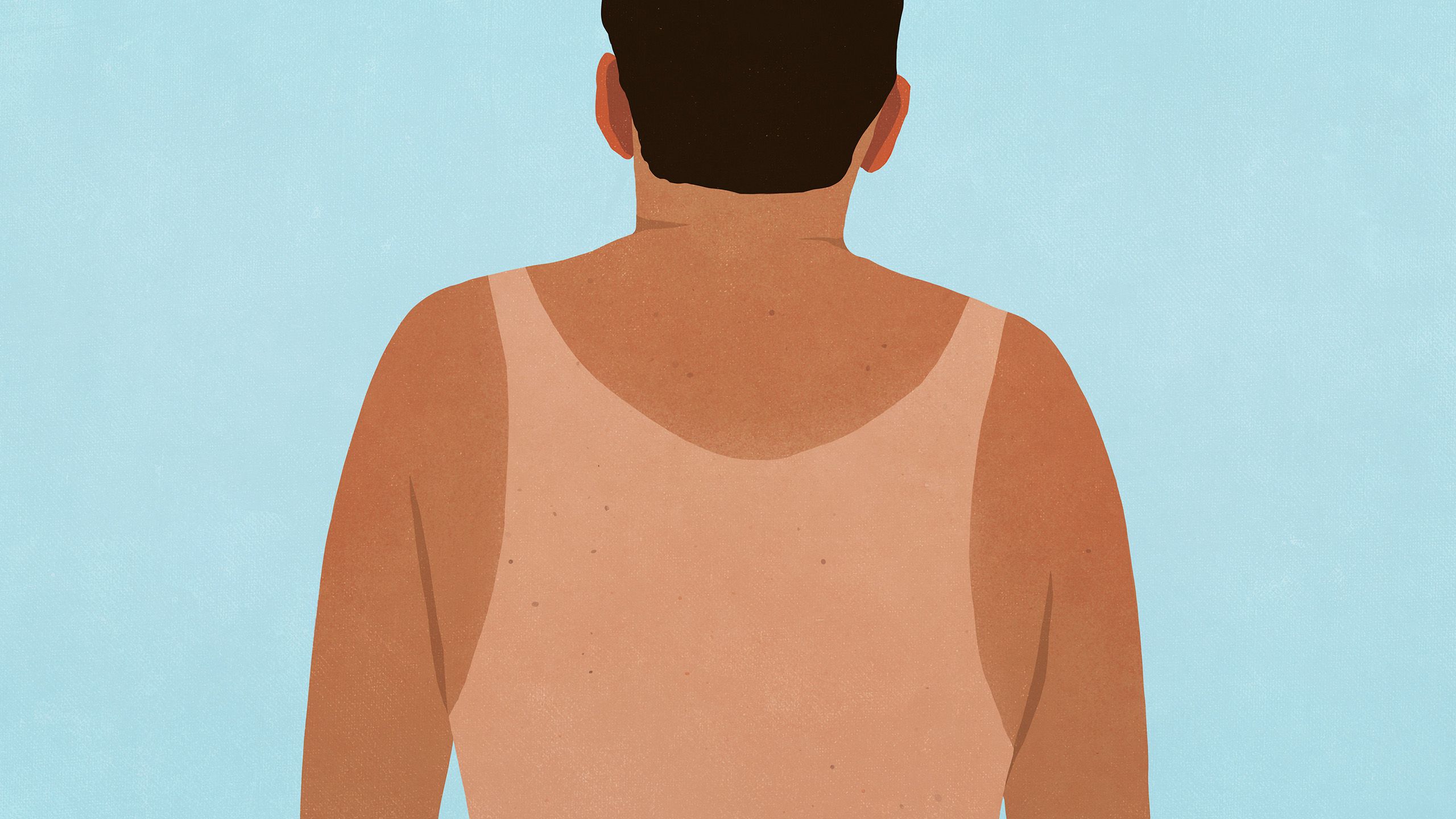 Illustration of a man's back with a singlet-shaped sunburn