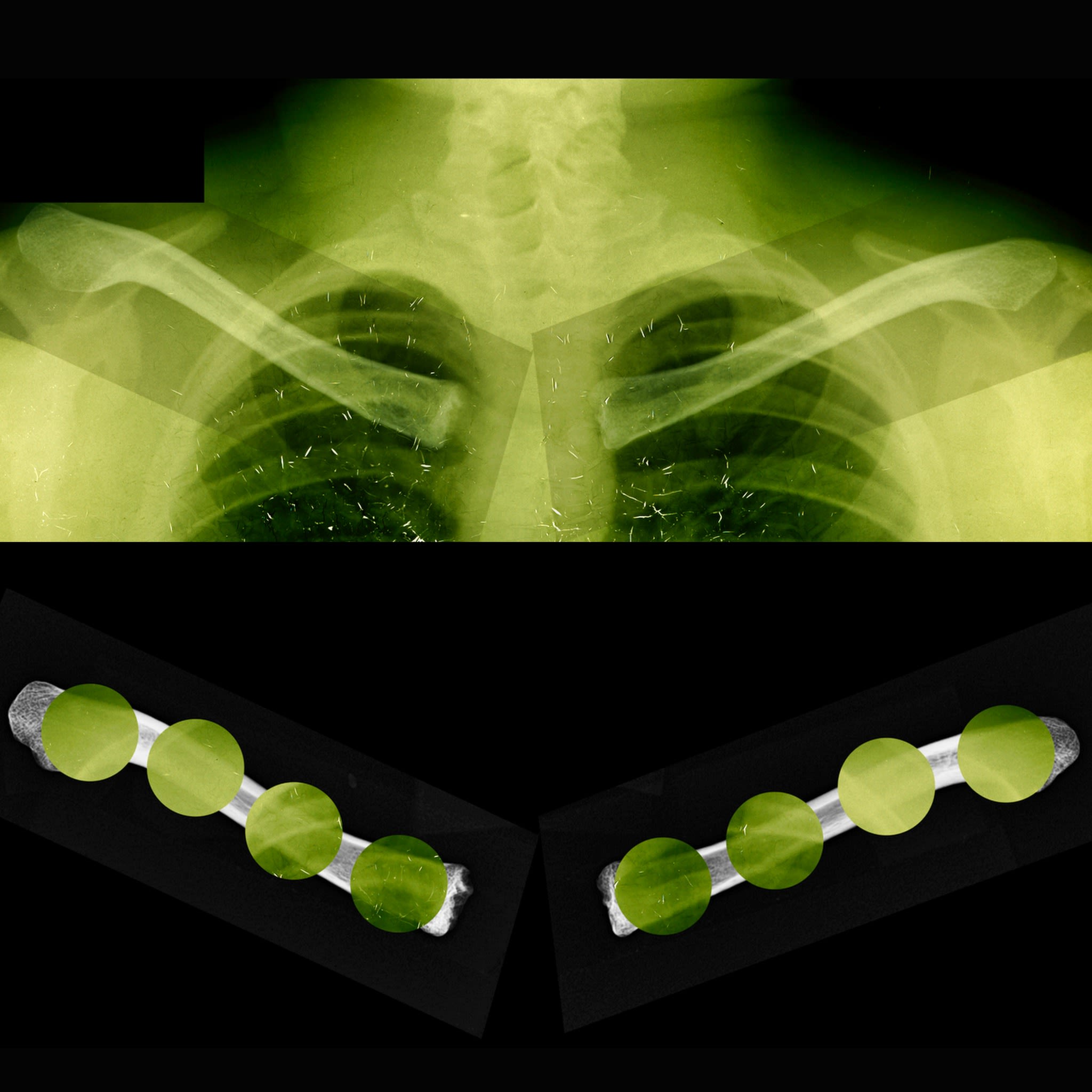 Final morphological checks for a match in the radiographic comparison process involve superimposition of the postmortem (PM) radiograph of the clavicles on the antemortem (AM) radiograph.