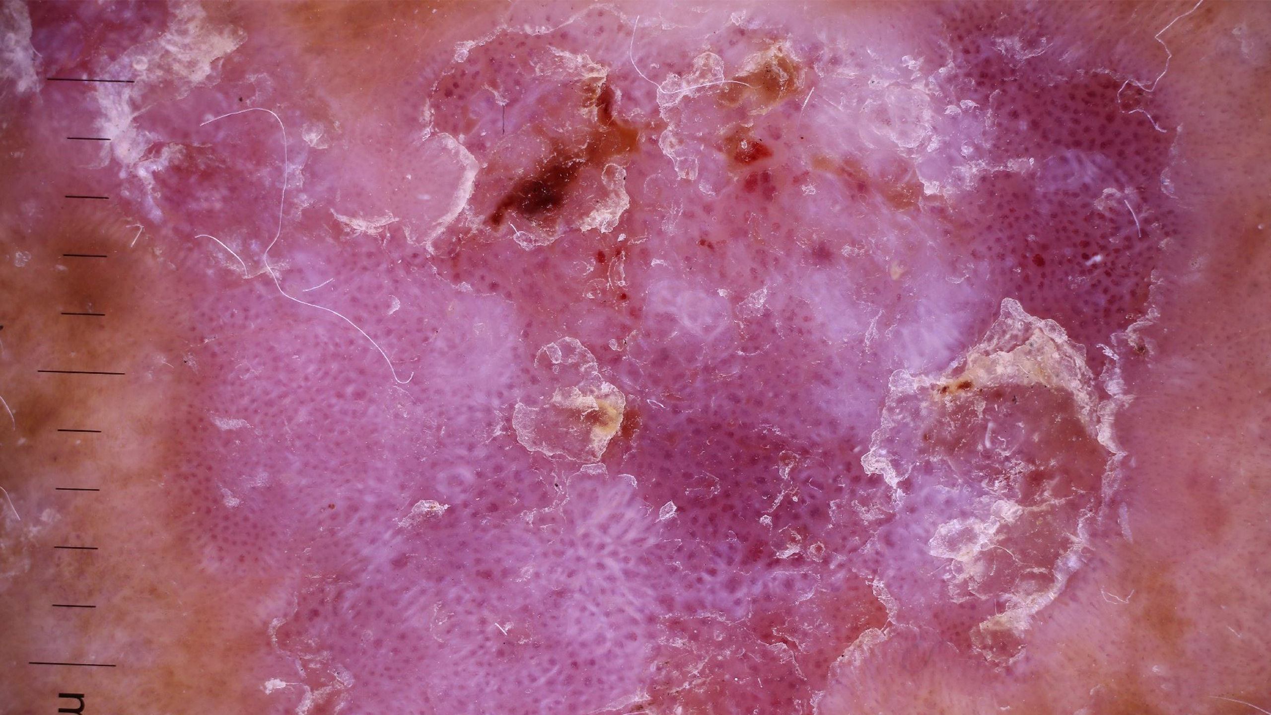 Squamous cell carcinoma (SCC) of the skin is the second most common form of skin cancer (The University of Queensland).