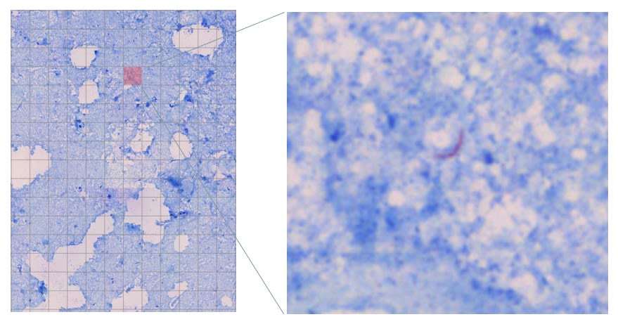 A blue slide image showing tuberculosis cells