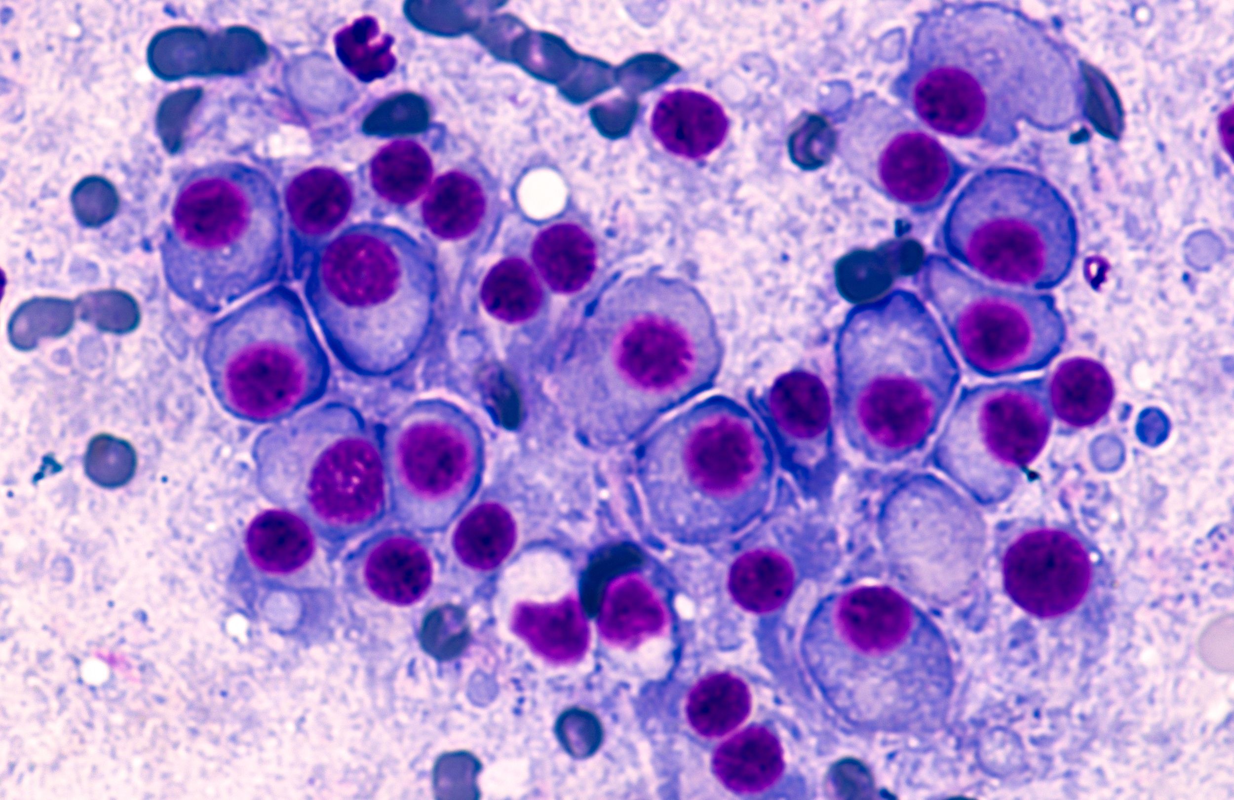 Slide of multiple myeloma cells
