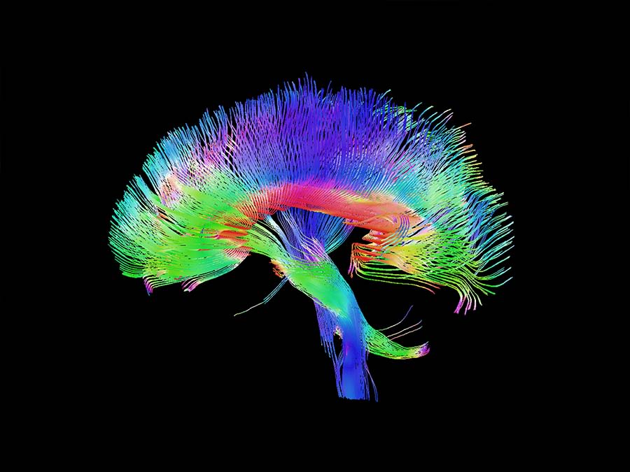 A tractography image reflecting major neural highways.